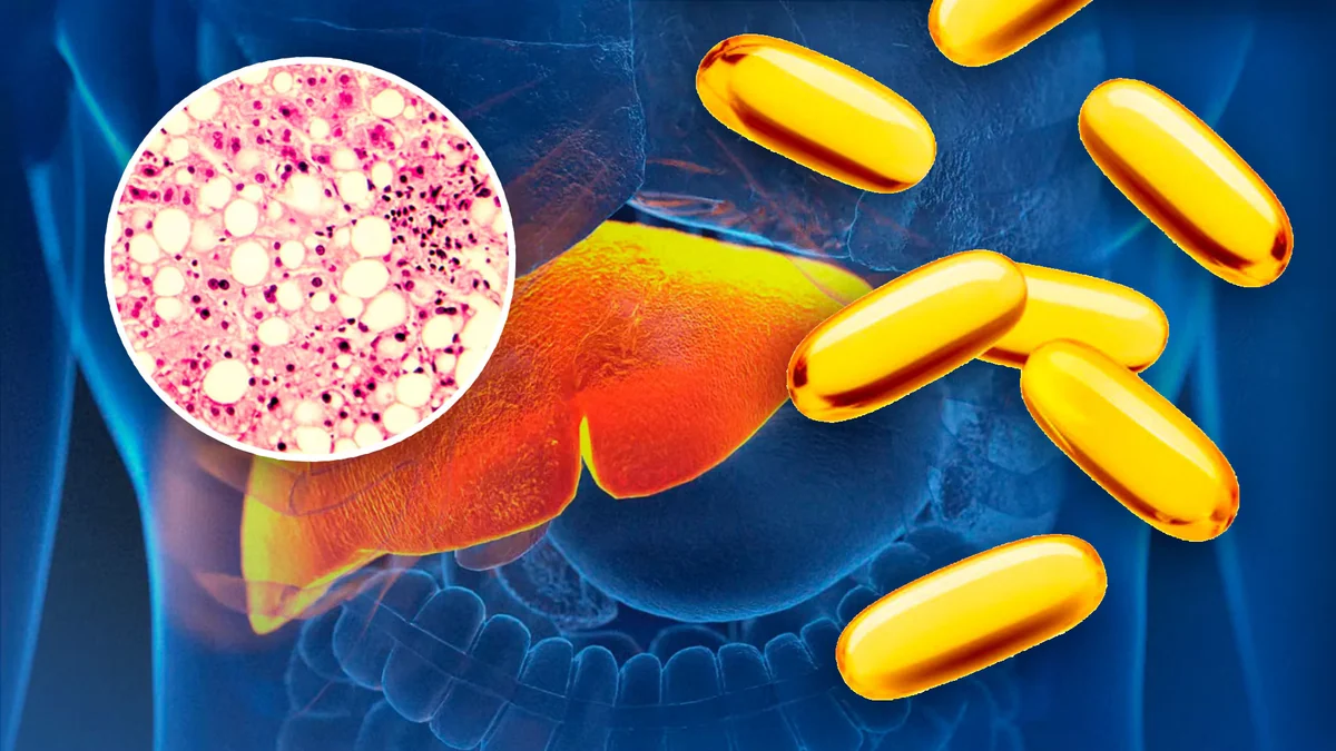 La vitamina que podría cambiar el tratamiento del hígado graso: estudio revela su potencial contra la esteatohepatitis