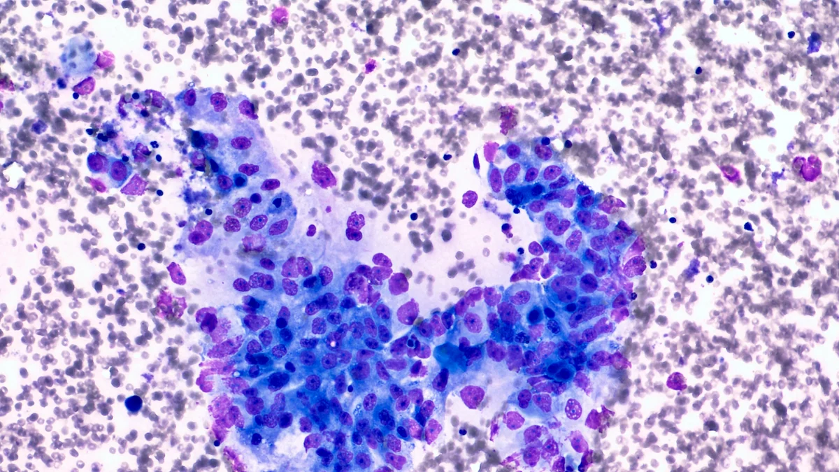 Desarrollan una vacuna para prevenir el cáncer de páncreas en personas de alto riesgo