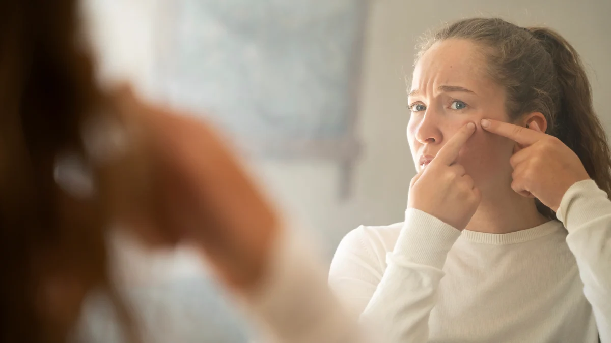 Epidemia de acné en la mujer adulta: cinco cambios en los hábitos de vida que pueden mejorarlo