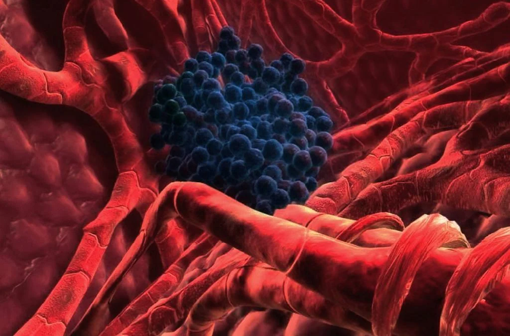 Cáncer de hígado: una nueva estrategia terapéutica mejora la supervivencia de los pacientes inicialmente inoperables