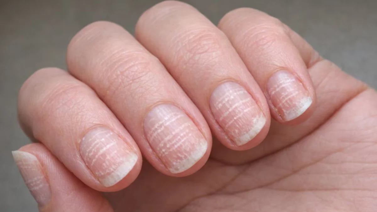 La verdadera razón por la que le salen rayas blancas en sus uñas: médico colombiano explica y da soluciones