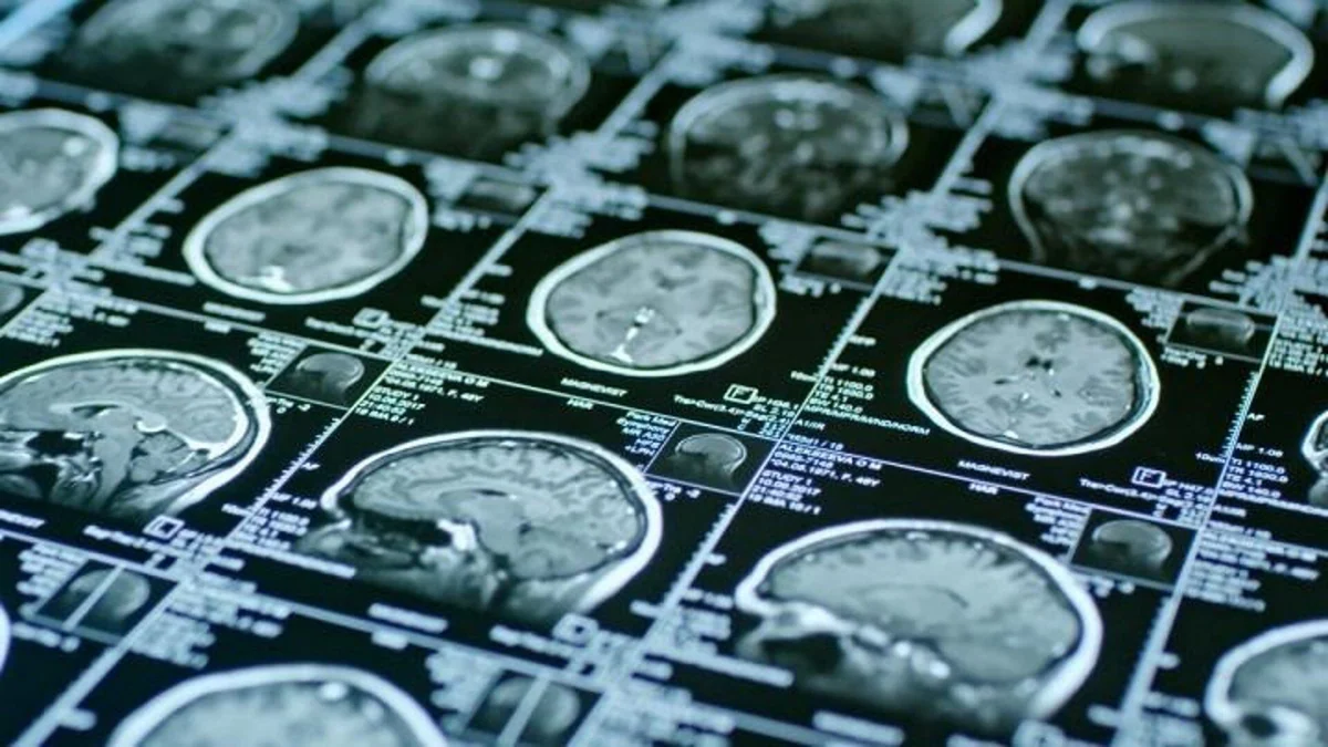 La SEN alerta de que los pacientes esperan una media de 109 días para una consulta de neurología