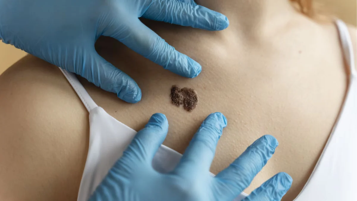 Pacientes con melanoma denuncian que siguen sin acceder a tratamientos pese a recomendación favorable del Estado
