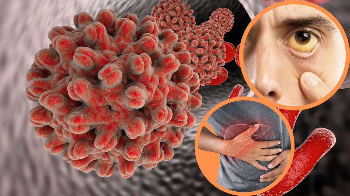 ¿La hepatitis B puede causar cáncer de hígado? Lo que debes saber sobre este virus y la vacuna que la previene