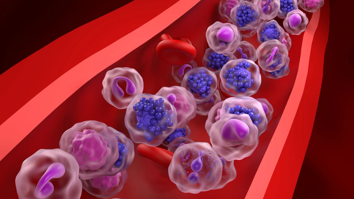 Analyse mit KI: So kann aggressiver Lymphdrüsenkrebs besser behandelt werden