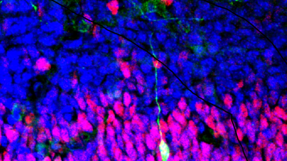 Parkinson, trapianto di staminali nel cervello di 8 pazienti