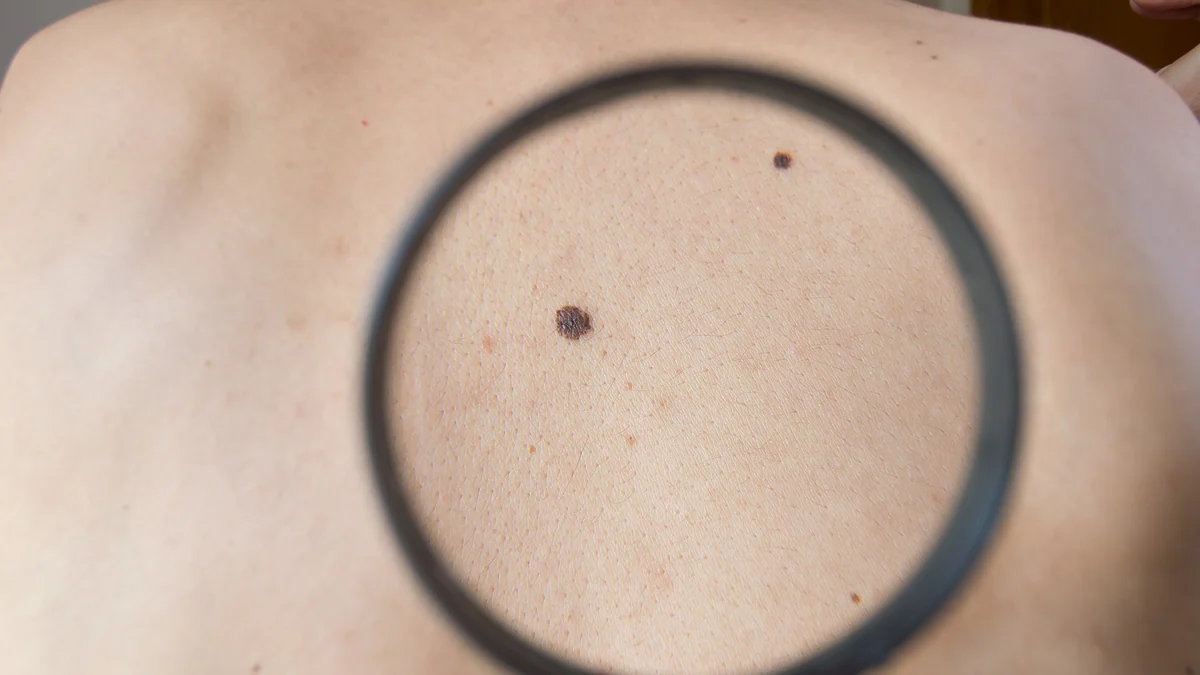 Una vacuna de ARNm reduce casi un 50% el riesgo de recaída en melanoma