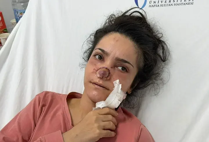 Eşi tarafından burnu ısırılıp koparılan İmran: Canımın acıyla balkondan atlamayı bile düşündüm