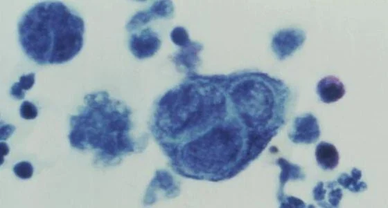 La nueva vacuna del herpes zóster reduce en casi un 90% los casos de la enfermedad entre mayores de 80 años